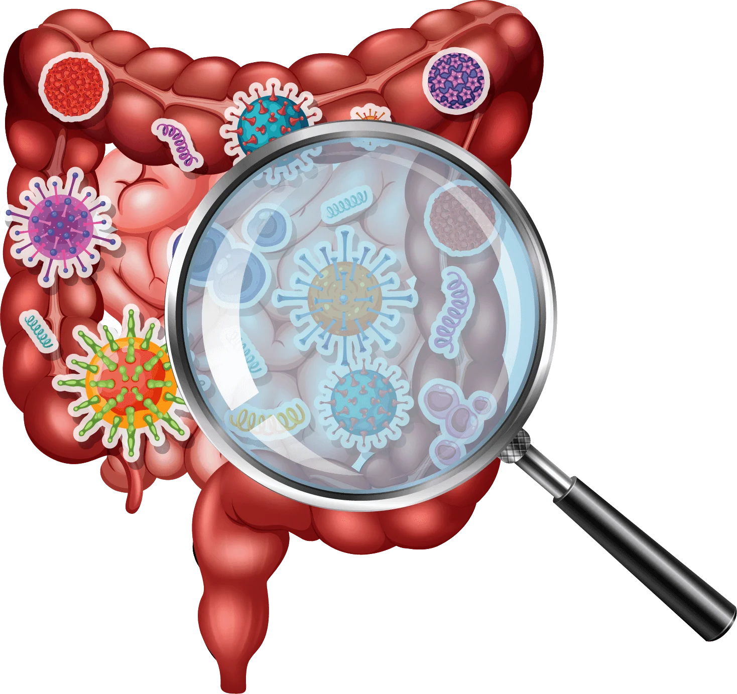 intestino inflamado